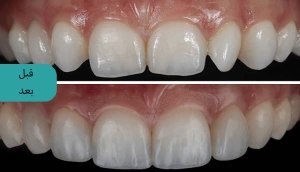 4 مورد از مهمترین عوارض کامپوزیت دندان 4 مورد از مهمترین عوارض کامپوزیت دندان