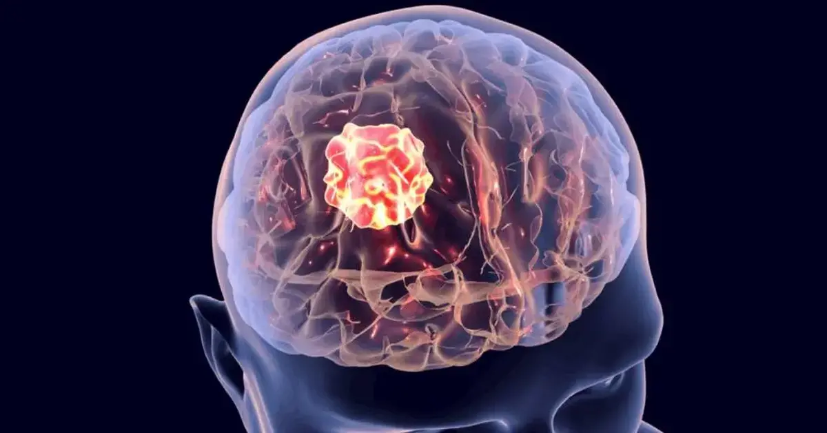 چه کسانی بیشتر در معرض خطر تومورهای مغزی هستند؟