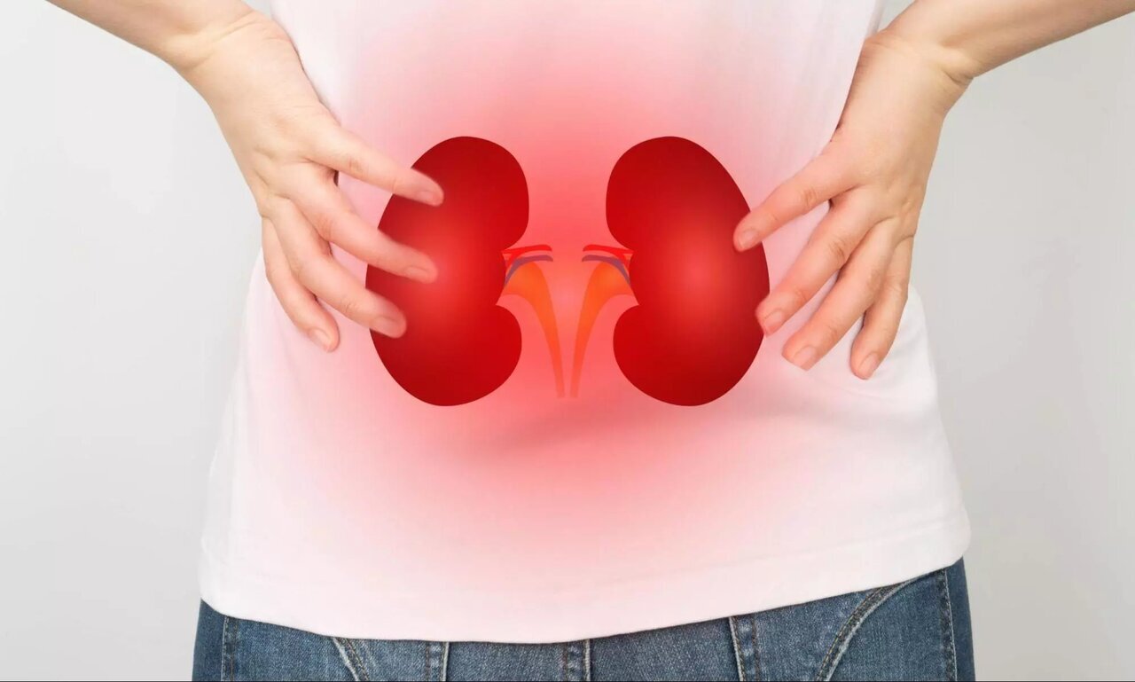 فعالیت در این ساعت ریسک سنگ کلیه را افزایش میدهد