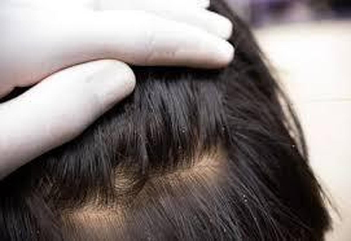 طاسی ارثی معمولاً از چه سنی آغاز میشود؟