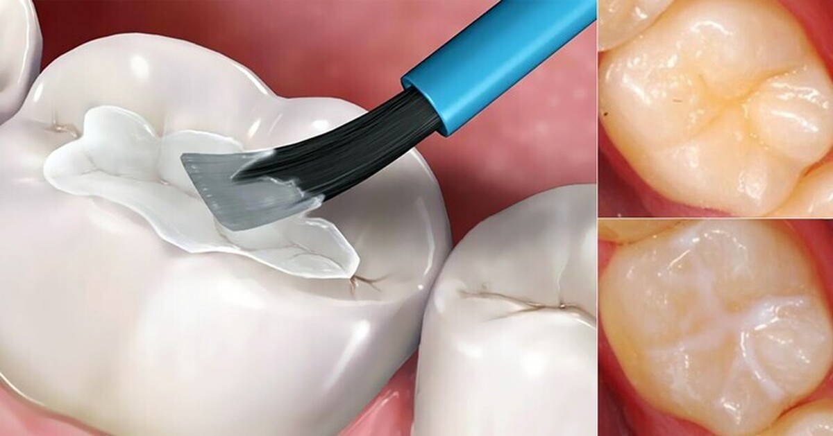 راهکارهای پیشگیری از پوسیدگی دندان